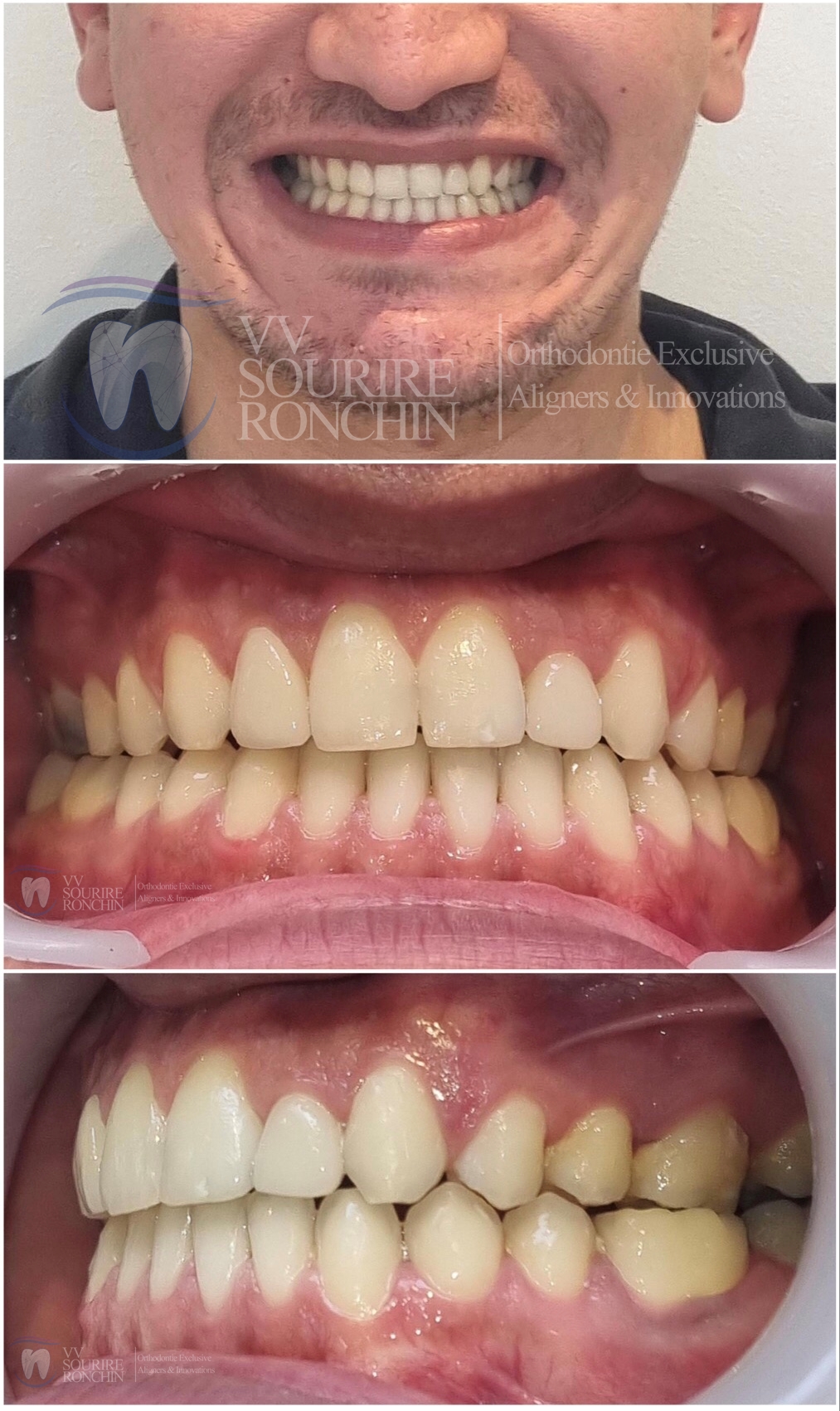 Cas Clinique Après Traitement d'une Agénésie des Incisives Latérales (Absence) et d'un Diastème (Espace entre les Dents) par Technique Invisalign en 7 Mois.