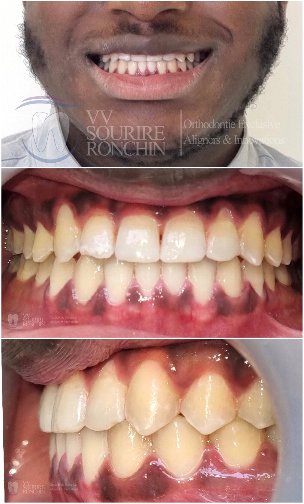 Cas Clinique Après Traitement d'un Articulé Croisé et d'une Classe 3 (Maxillaire en Arrière, Mandibule en Avant) par technique Invisalign en 15 Mois.