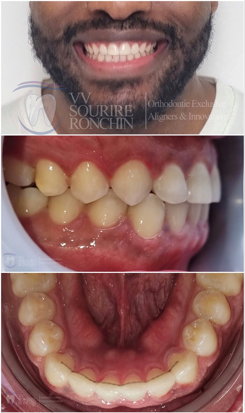 Cas Clinique Après Traitement d'un Articulé Croisé Antérieur et de Diastèmes Interdentaires (Espace entre les Dents) par technique Invisalign en 12 Mois.