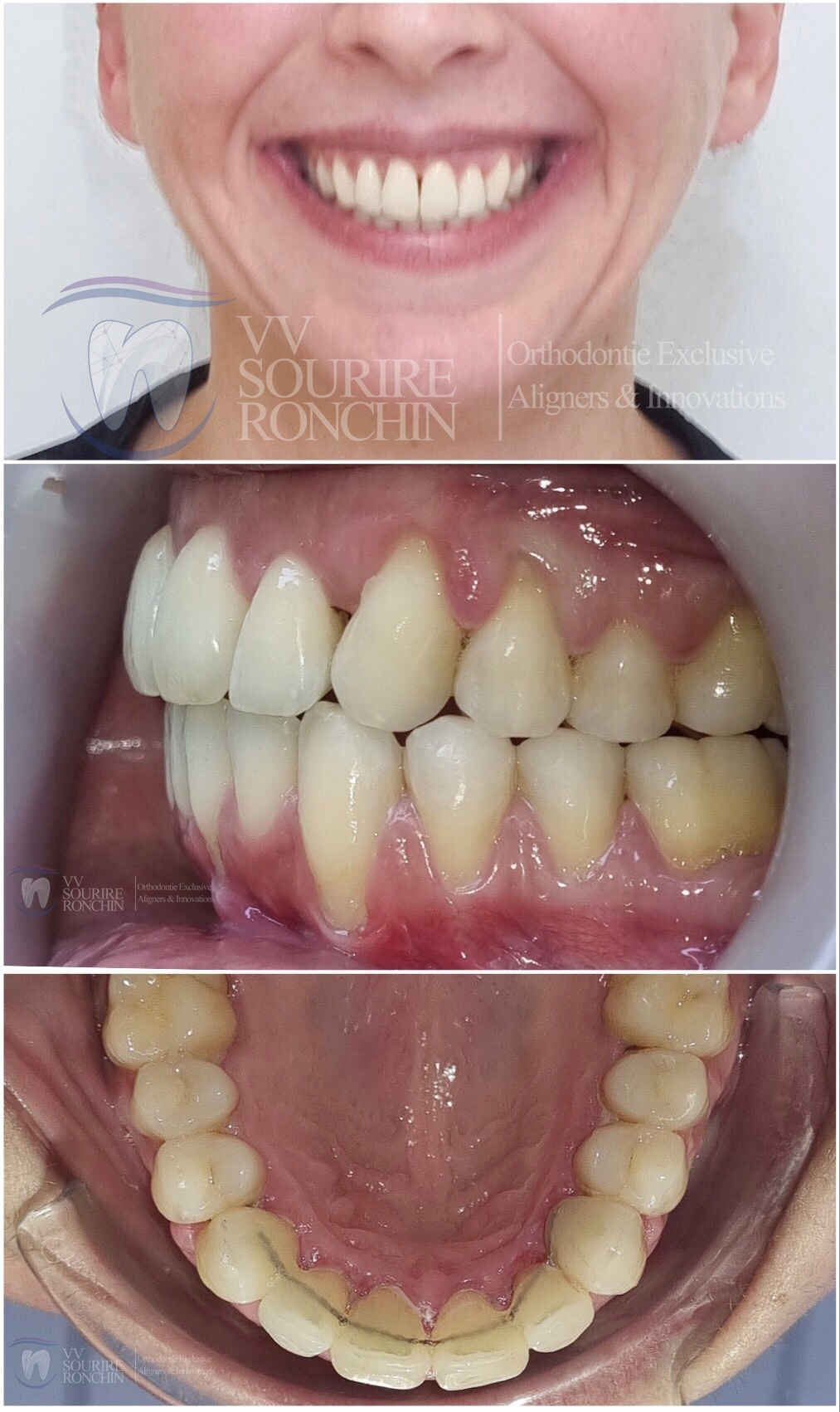 Cas Clinique Après Traitement d'un Encombrement et d'une Classe 2 (Maxillaire en Avant, Mandibule en Arrière) en Technique Invisalign en 15 Mois.