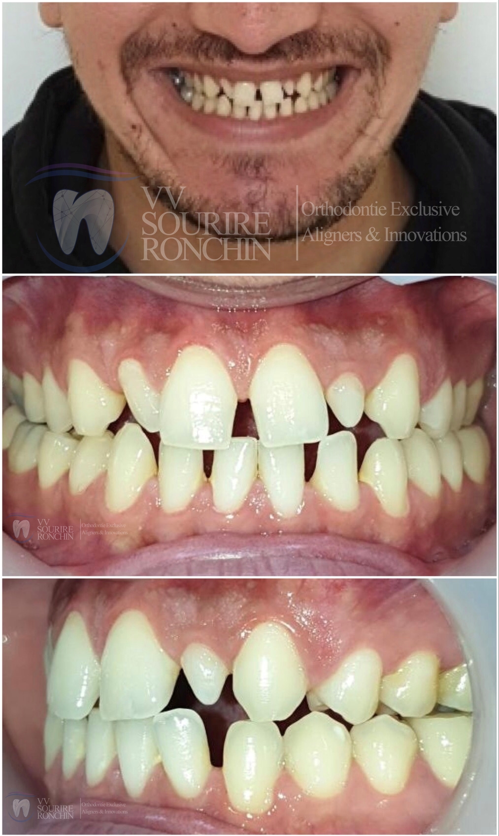 Cas Clinique Avant Traitement d'une Agénésie des Incisives Latérales (Absence) et d'un Diastème (Espace entre les Dents) par Technique Invisalign en 7 Mois.