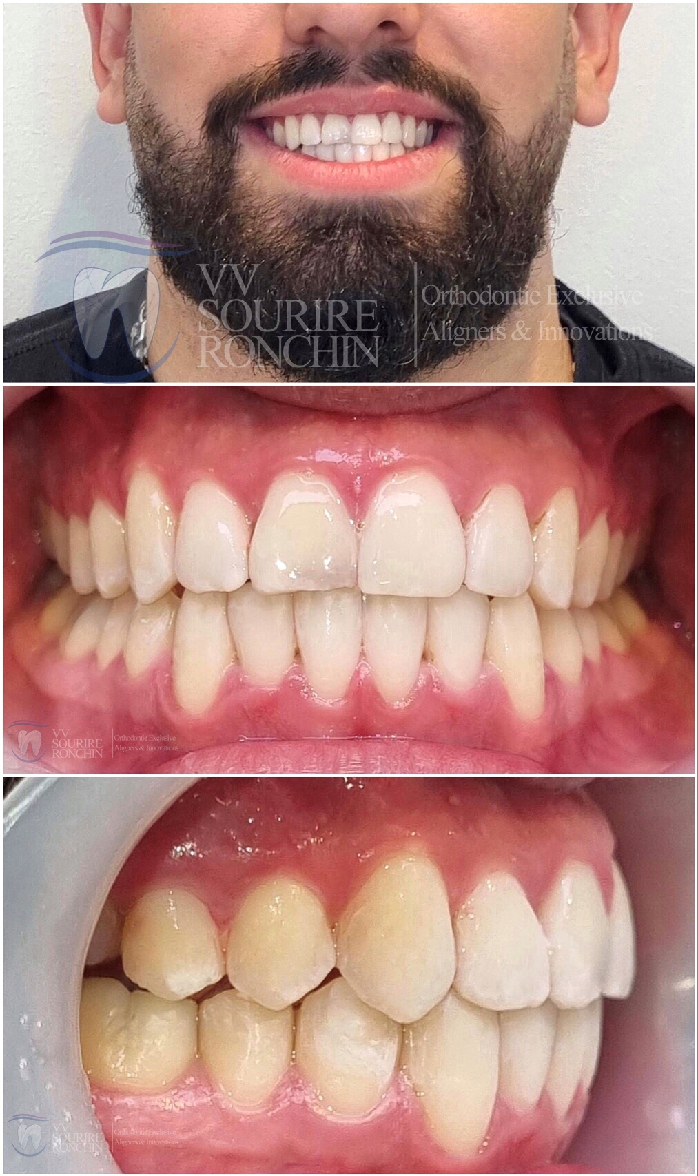 Cas Clinique Après Traitement d'un Articulé Croisé Antérieure, d'une Classe 3 (Maxillaire en Arrière, Mandibule en Avant) et d'un Encombrement Sévère en technique Invisalign en 13 Mois.