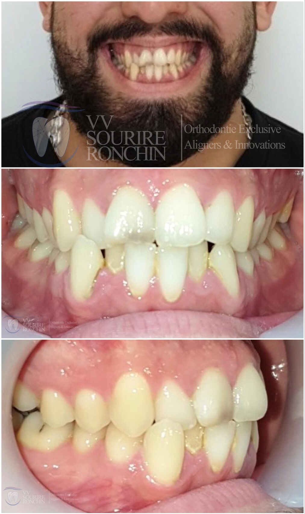 Cas Clinique Avant Traitement d'un Articulé Croisé Antérieure, d'une Classe 3 (Maxillaire en Arrière, Mandibule en Avant) et d'un Encombrement Sévère en technique Invisalign en 13 Mois.