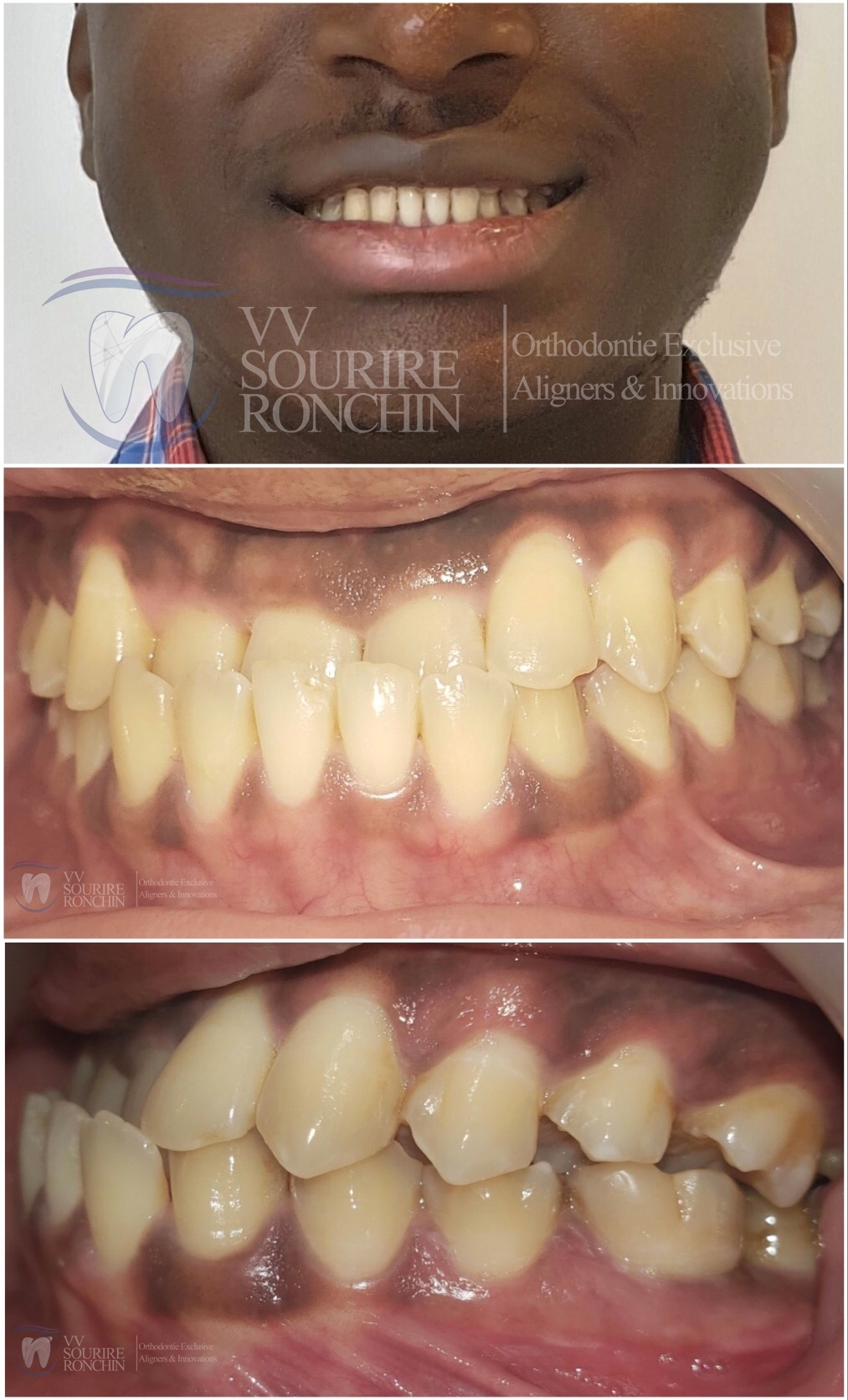 Cas Clinique Avant Traitement d'un Articulé Croisé et d'une Classe 3 (Maxillaire en Arrière, Mandibule en Avant) par technique Invisalign en 15 Mois.