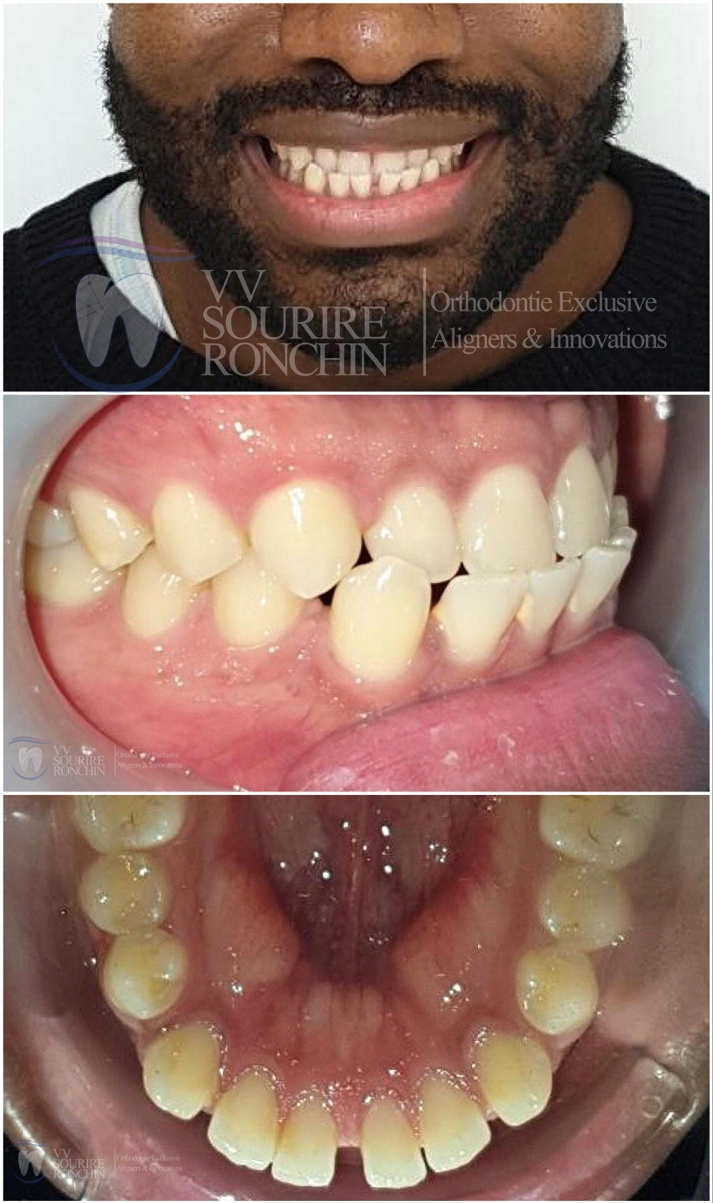 Cas Clinique Avant Traitement d'un Articulé Croisé Antérieur et de Diastèmes Interdentaires (Espace entre les Dents) par technique Invisalign en 12 Mois.