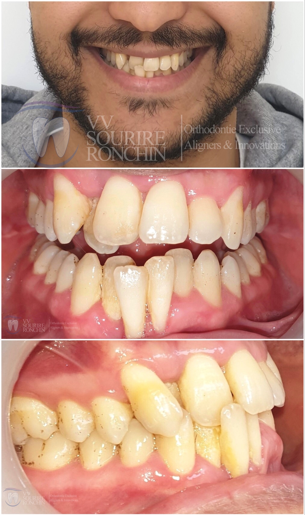 Cas Clinique Avant Traitement d'un Articulé Croisé Antérieure et d'un Encombrement Sévère en technique Invisalign en 15 Mois.