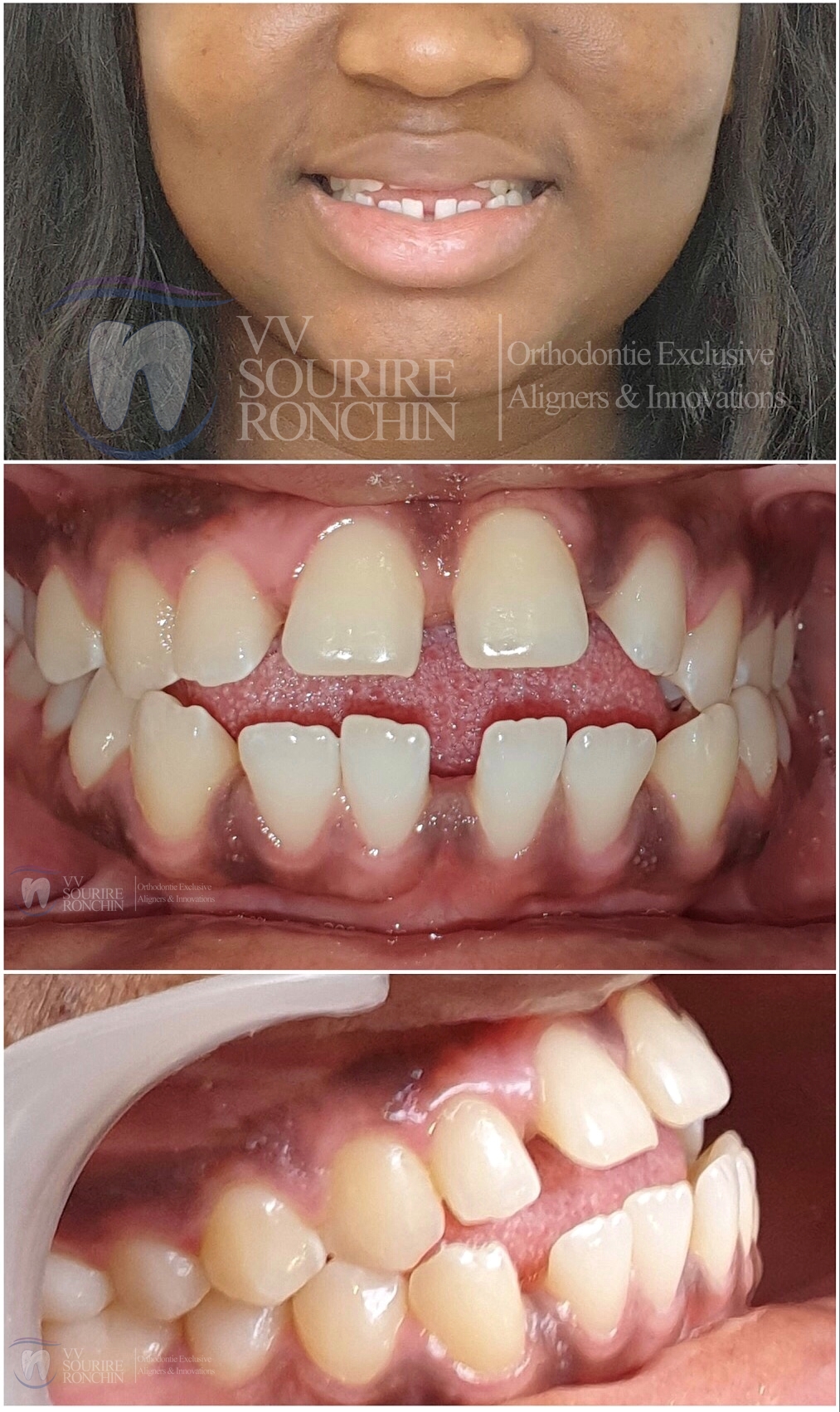 Cas Clinique Avant Traitement d'une Béance Sévère dû à la la Langue et d'un Articulé Croisé Gauche Invisalign en 20 Mois