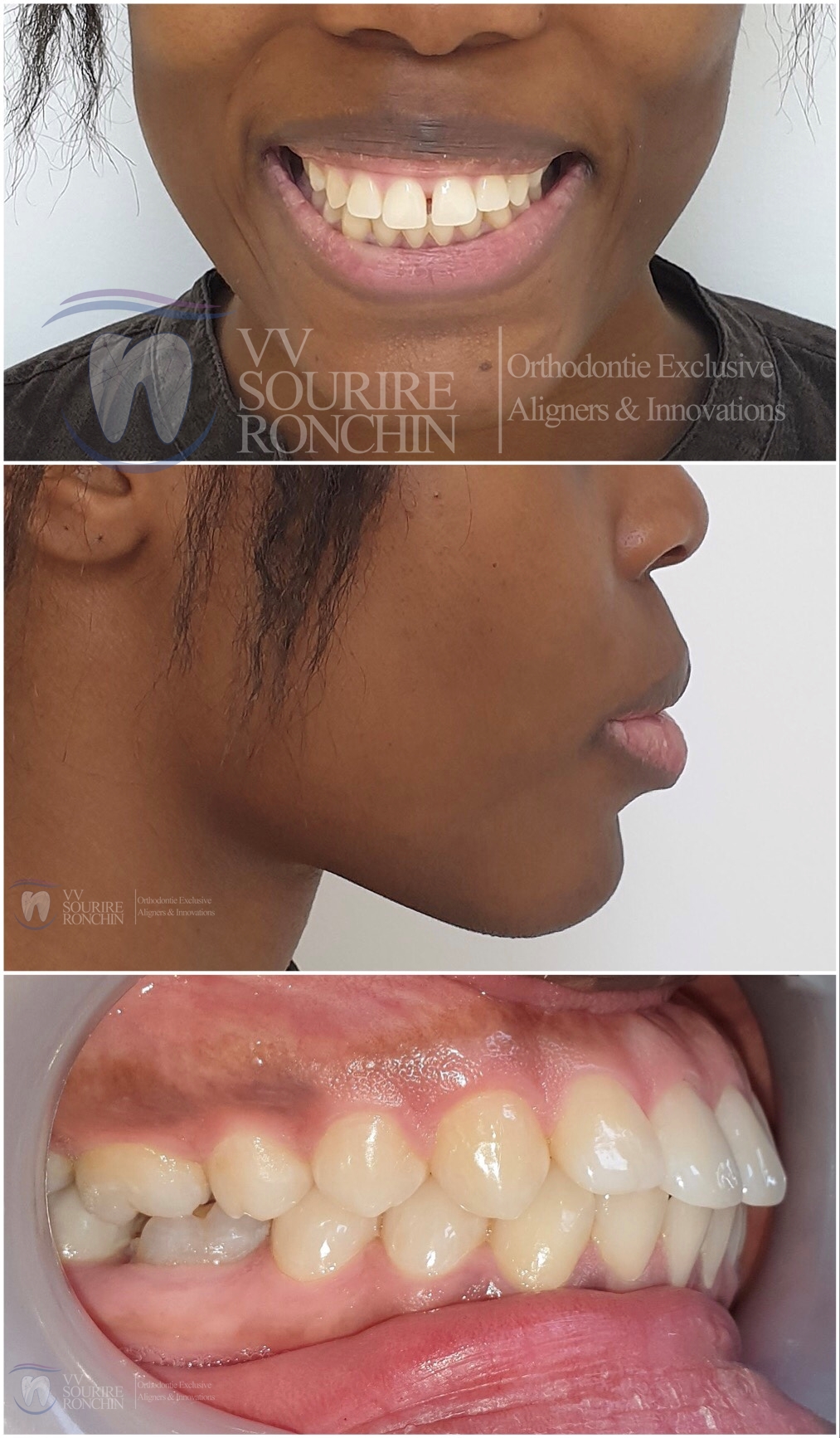 Cas Clinique Avant Traitement d'un Diastème (Espace entre les Dents) sur une Récidive de Traitements Orthodontiques par Technique Invisalign en 11 Mois