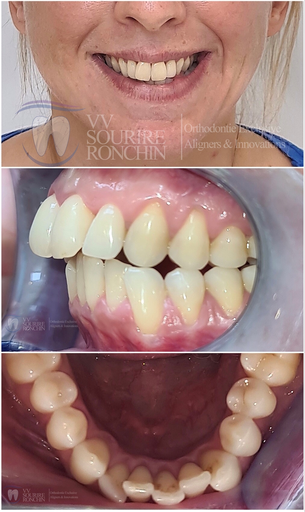 Cas Clinique Avant Traitement d'un Encombrement et d'une Classe 2 (Maxillaire en Avant, Mandibule en Arrière) en Technique Invisalign en 15 Mois.