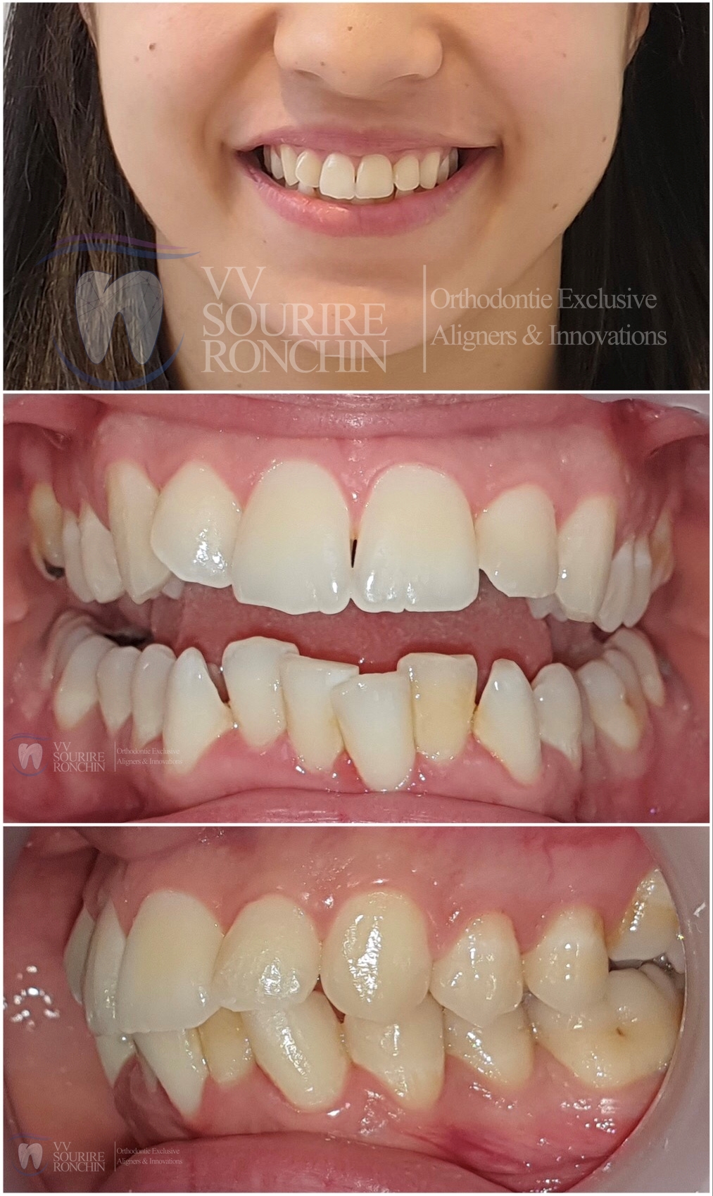 Cas Clinique Avant Traitement Encombrement Complexe Invisalign en 12 Mois