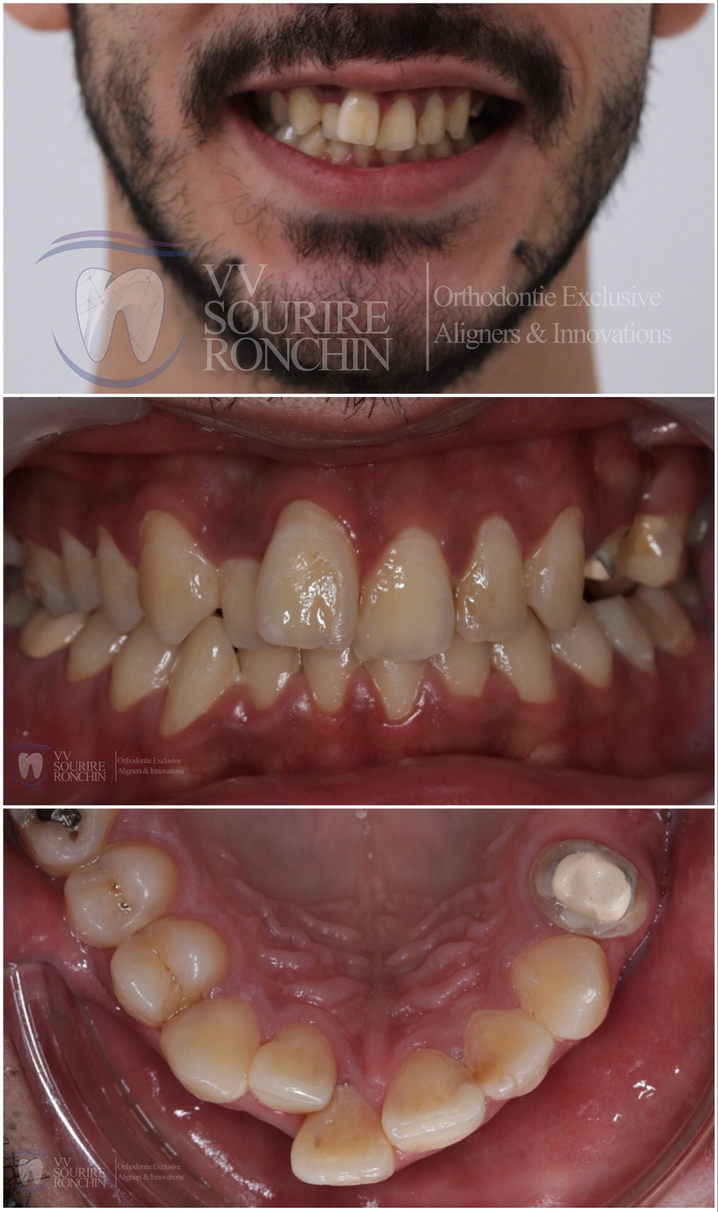 Cas Clinique Avant Traitement d'un Encombrement Sévère Incisive Latérale réalisé par Invisalign Technique en 12 mois